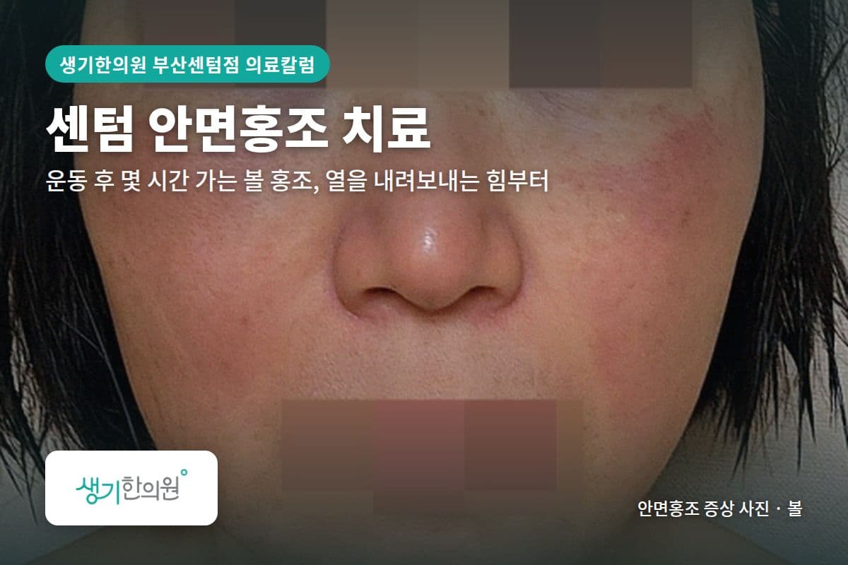 볼 안면홍조 증상 사진과 문구 「센텀 안면홍조 치료, 운동 후 몇 시간 가는 볼 홍조, 열을 내려보내는 힘부터 · 생기한의원 부산센텀점」
