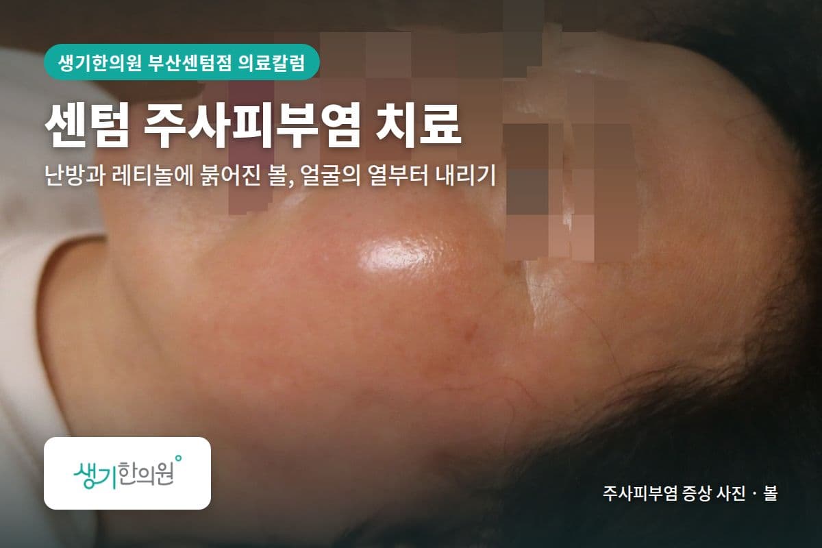 볼 주사피부염 증상 사진과 문구 「센텀 주사피부염 치료, 난방과 레티놀에 붉어진 볼, 얼굴의 열부터 내리기 · 생기한의원 부산센텀점」