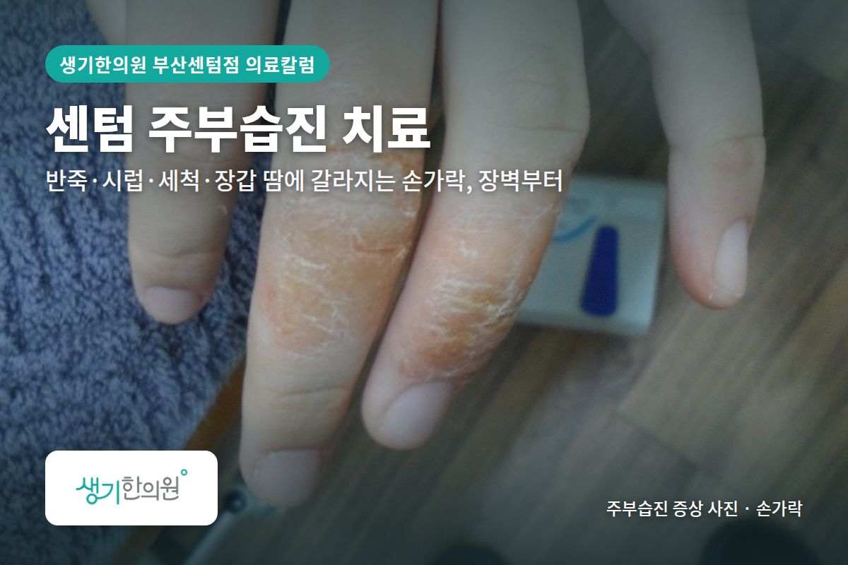 손가락 주부습진 증상 사진과 문구 「센텀 주부습진 치료, 반죽·시럽·세척·장갑 땀에 갈라지는 손가락, 장벽부터 · 생기한의원 부산센텀점」